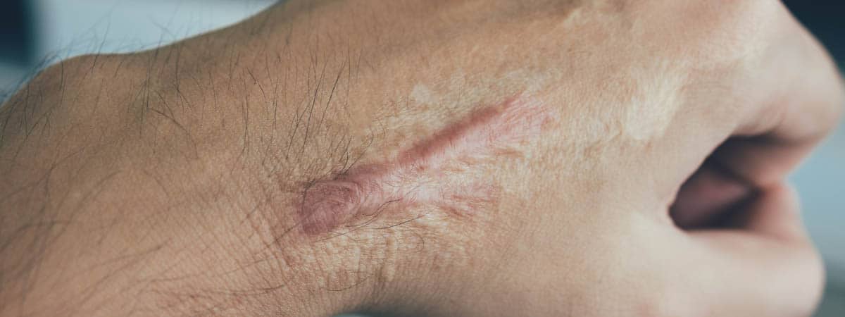 Keloid Scars