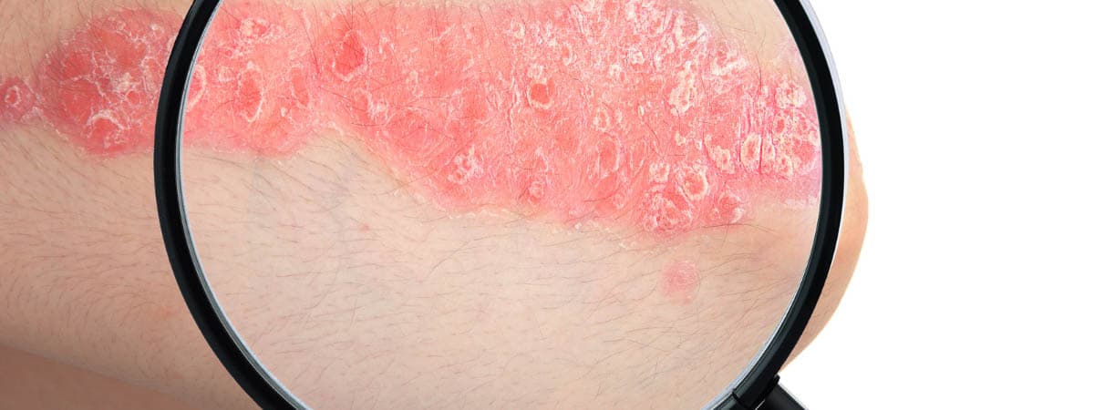 Psoriasis