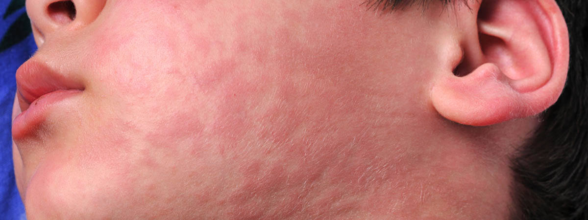 Urticaria